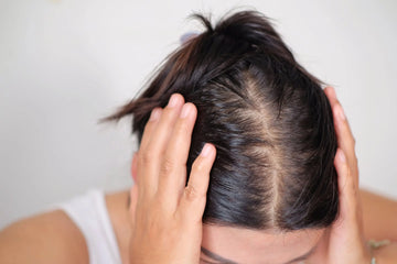 Cara Cepat Menumbuhkan Rambut Botak dalam 1 Minggu